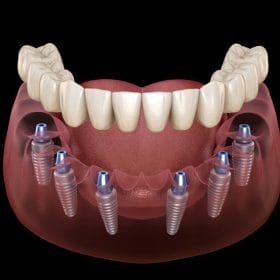 trong-rang-implant-all-on-6