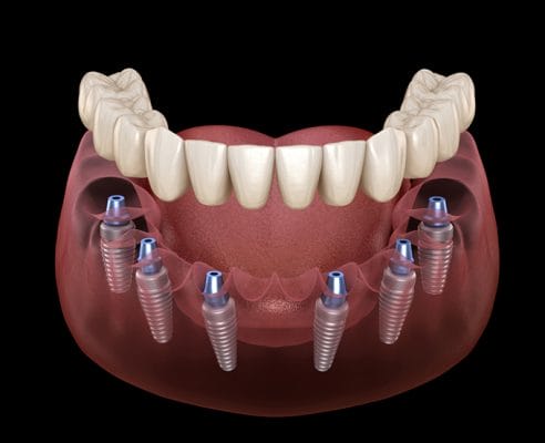 trong-rang-implant-all-on-6