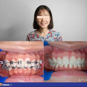 chinh nha nieng rang mac cai kim loai gia bao nhieu tien