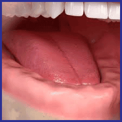 all on 4 implant