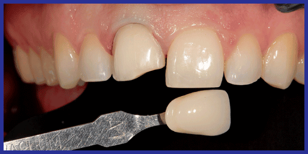 veneer