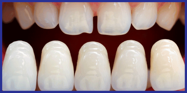 veneer