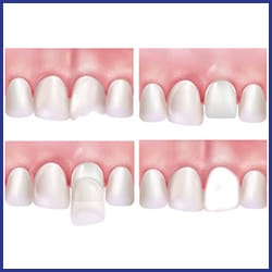 veneer