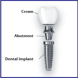 Implant – Include Crowns – Navii Dental Care