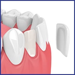 porcelain-veneers