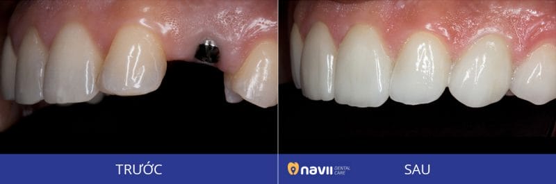 trồng răng Implant