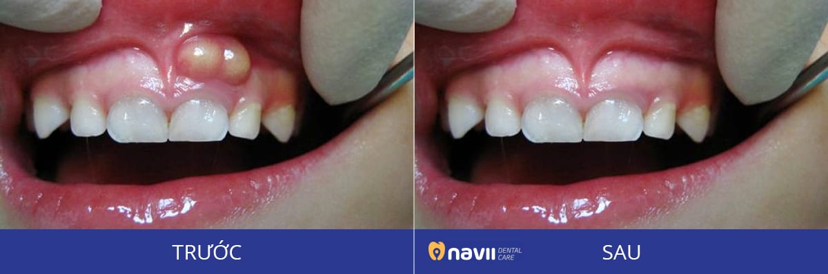 ĐIỀU TRỊ ÁP-XE RĂNG