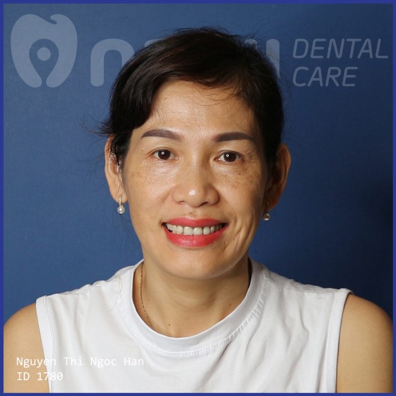 trồng răng implant