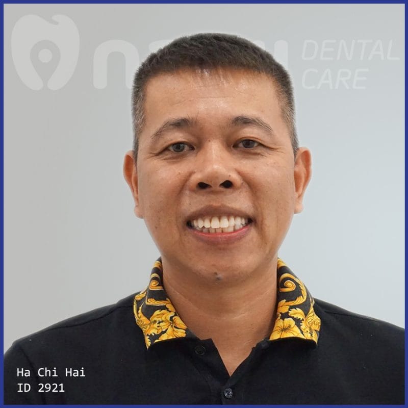 TRỒNG RĂNG ALL ON 4 REVIEW