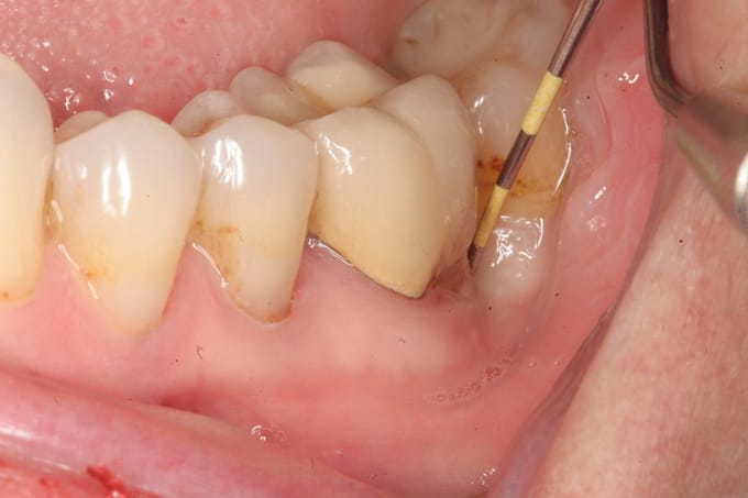 Áp xe răng - Cười tươi rạng rỡ với hàm răng đều và gọn gàng là điều bất ngờ đơn giản với áp xe răng. Với sự giúp đỡ từ các chuyên gia và công nghệ hiện đại, áp xe răng giờ đây không còn là nỗi lo sợ nữa. Những hậu quả tiêu cực của răng khấp kếch trước đây sẽ không còn là vấn đề, vì hàm răng của bạn sẽ được kết cấu hoàn chỉnh và duy trì được bền vững.