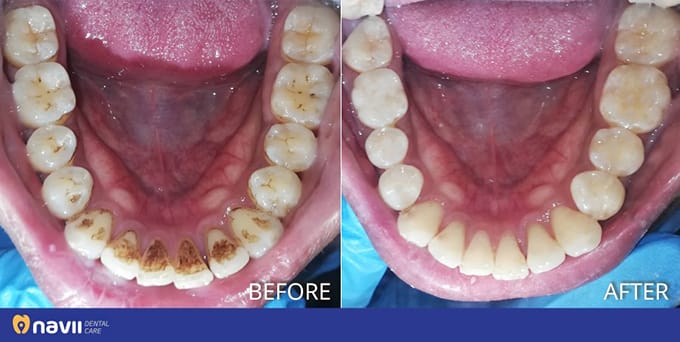 Dịch vụ Lấy Cao Răng và Đánh Bóng – Navii Dental Care