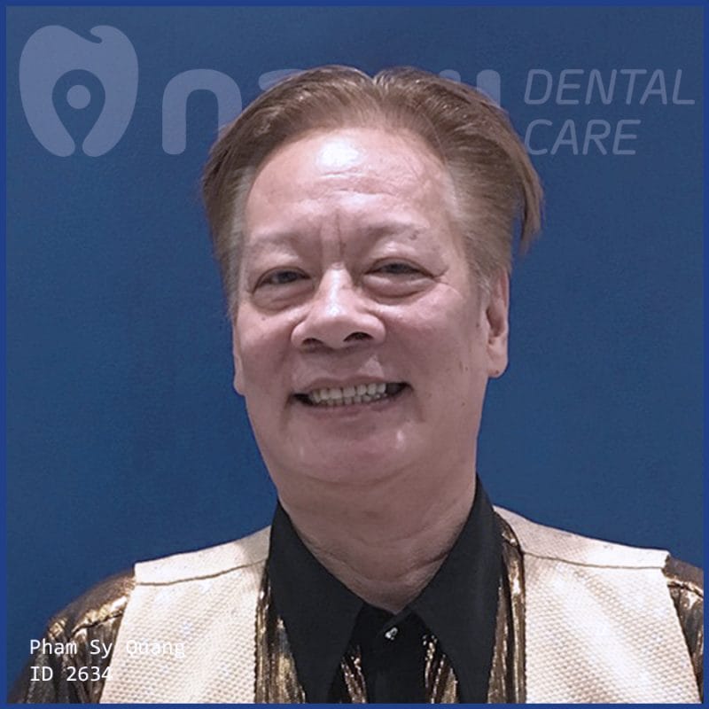 gia-trong-rang-implant-all-on-6