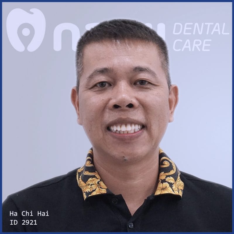 trong-rang-implant-all-on-4