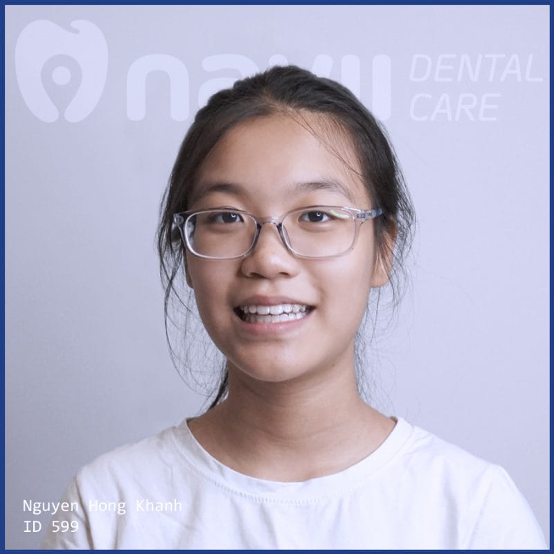 nieng-rang-invisalgin-bao-nhieu-tien