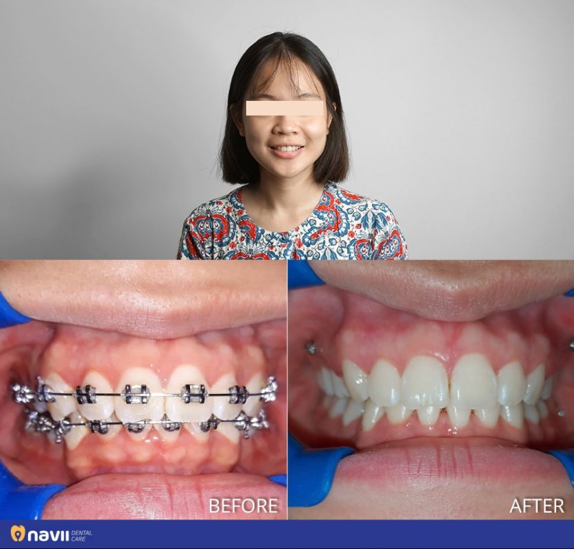 chinh nha nieng rang mac cai kim loai gia bao nhieu tien